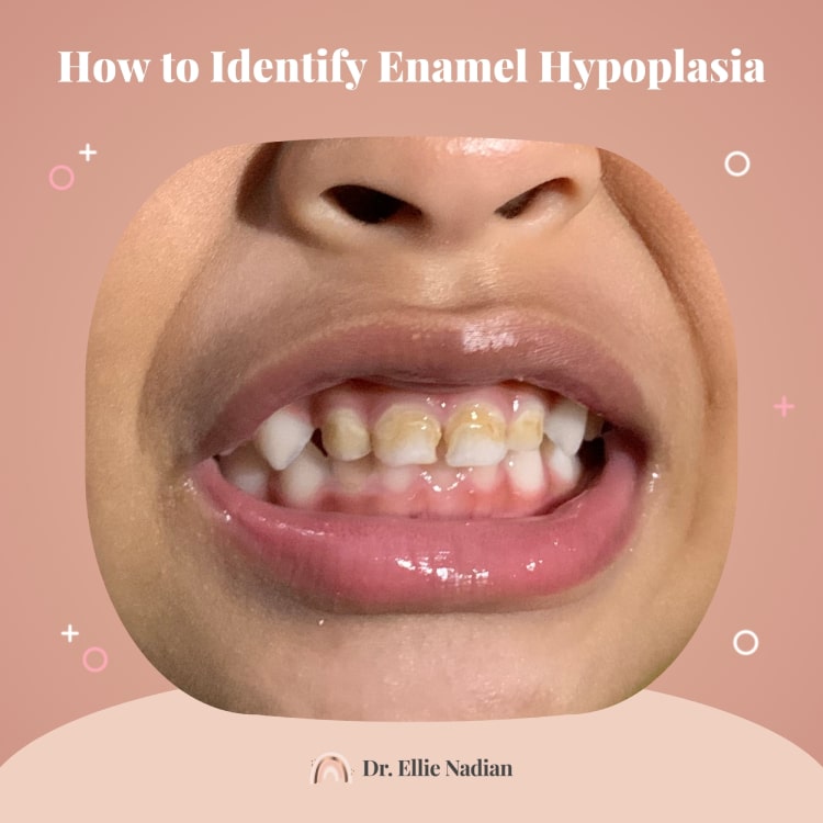 how enamel hypoplasia in children looks like