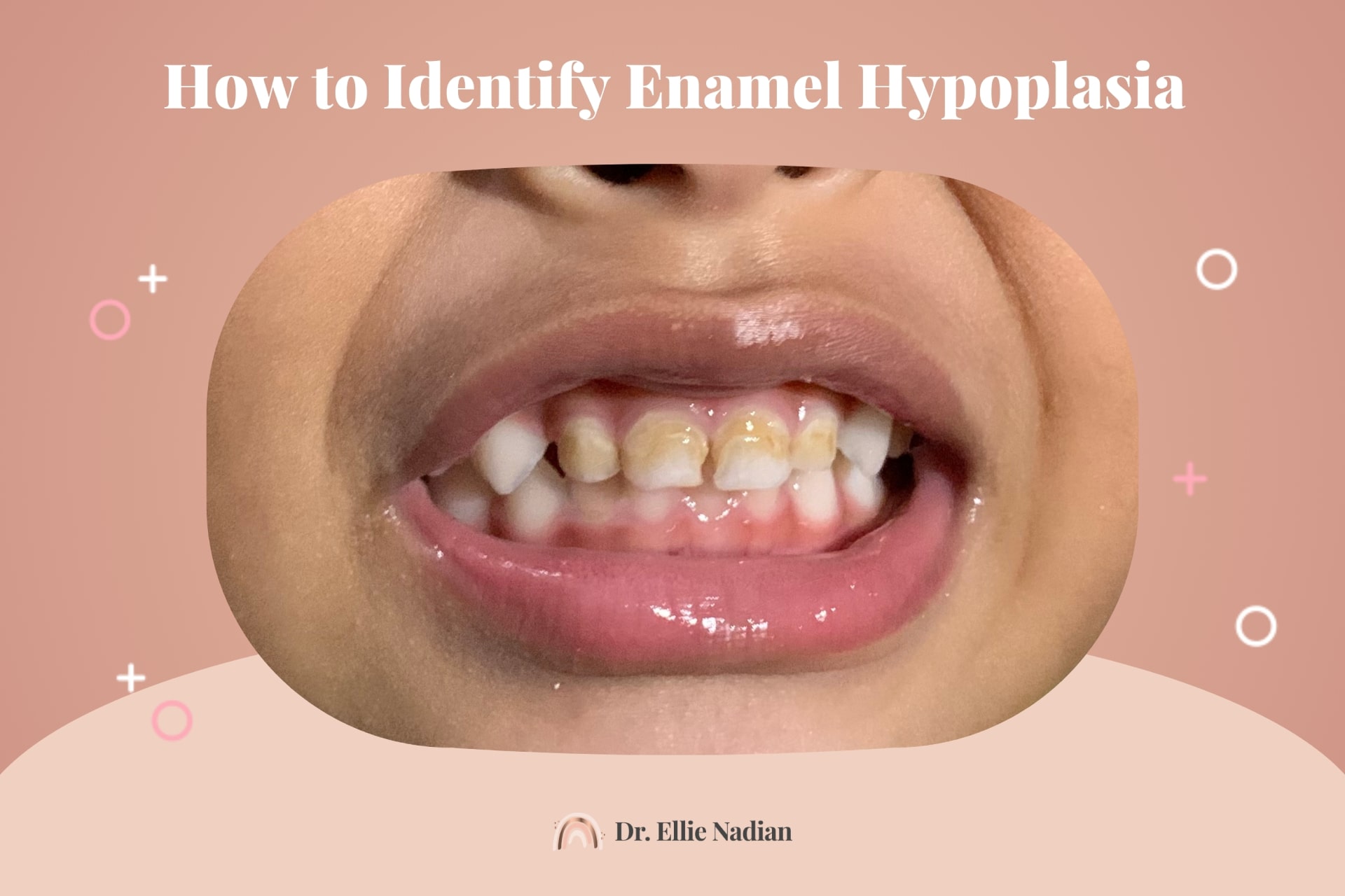 how to identify enamel hypoplasia