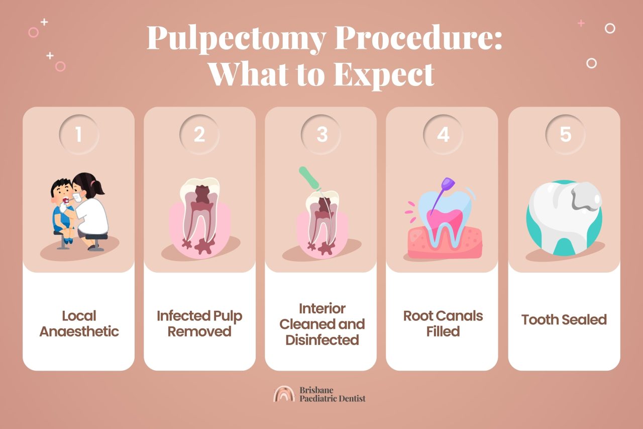 What to Expect in a Pulpectomy Procedure