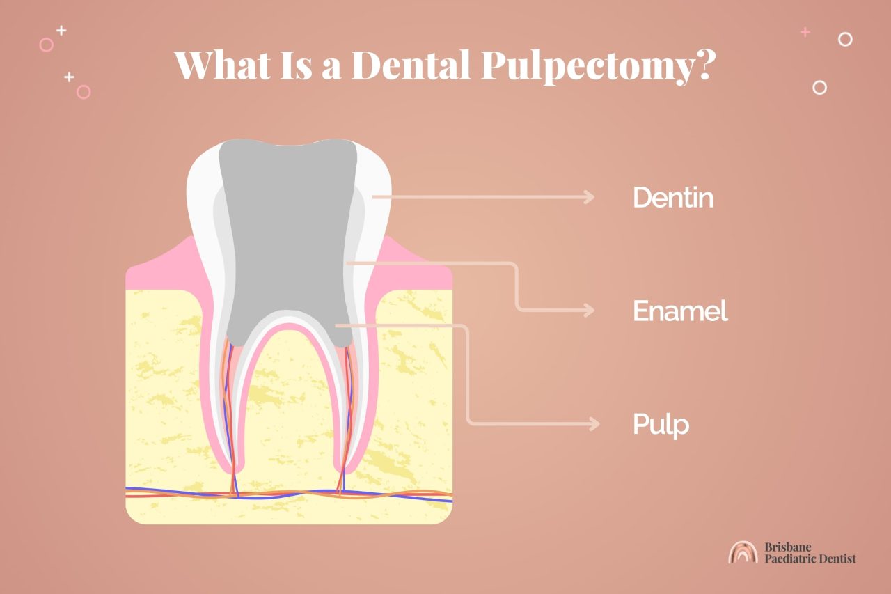 What is a dental pulpectomy?