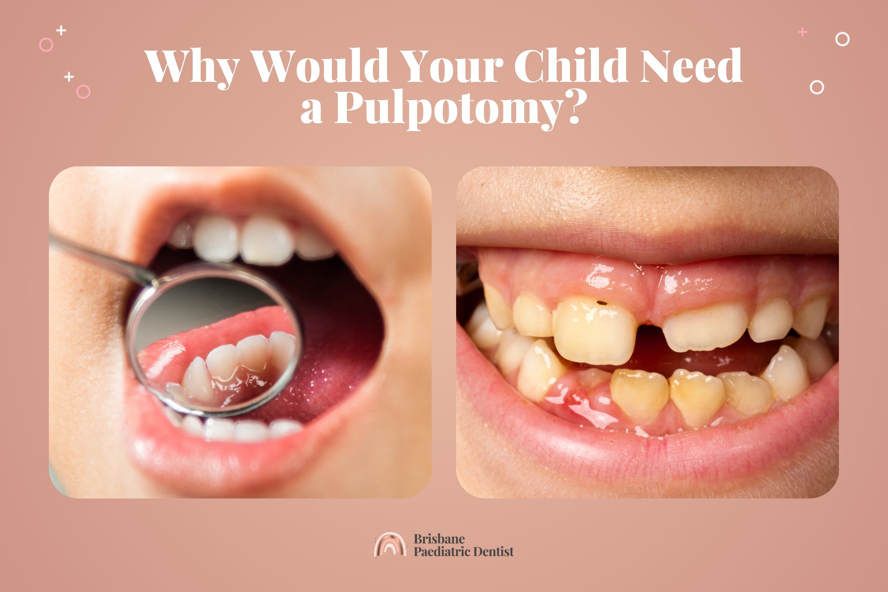 Why would your child need a pulpotomy